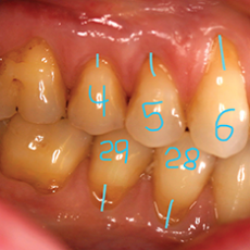 CTG-1 Pre Op